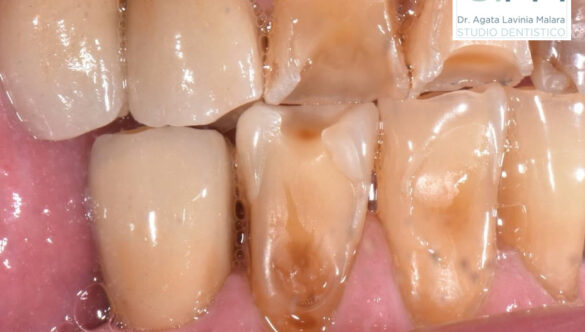 Erosione dentale