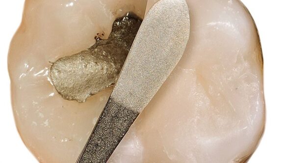L’ amalgama dentale: le otturazioni di metallo