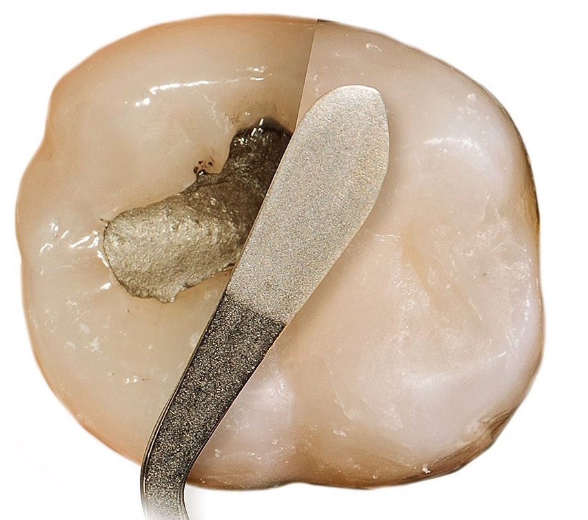L’ amalgama dentale: le otturazioni di metallo