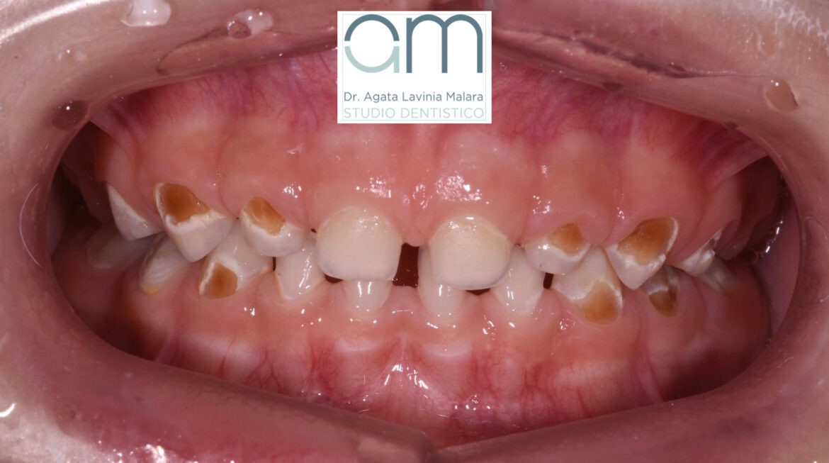 Carie precoce dei denti da latte