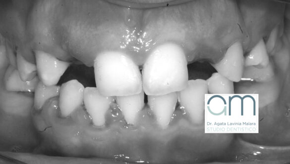 Agenesia dentale