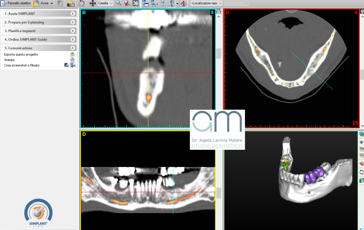 Chirurgia implantare tac guidata