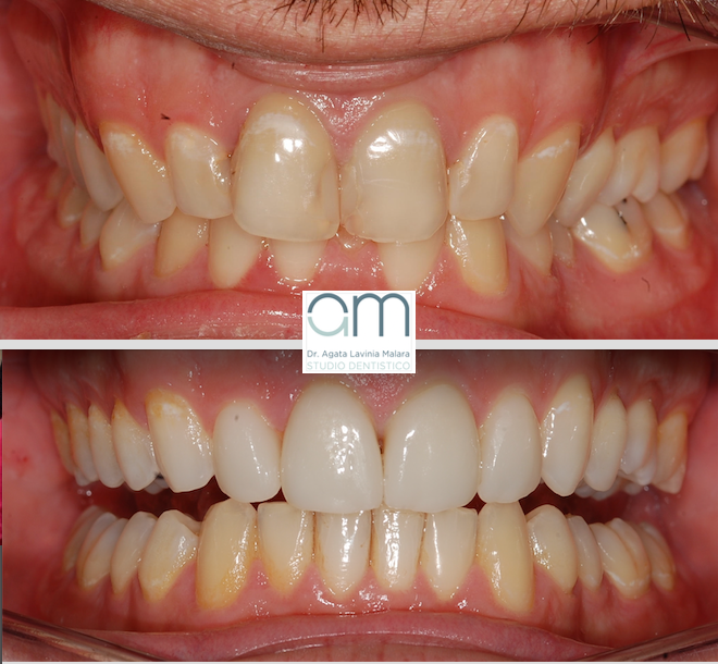 Faccette dentali o veneers - Studio Dentistico Malara - Reggio Calabria