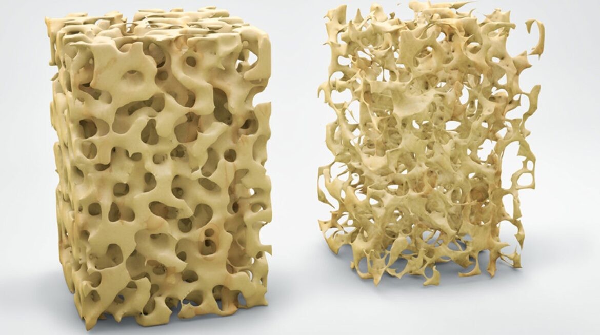 Osteoporosi e denti