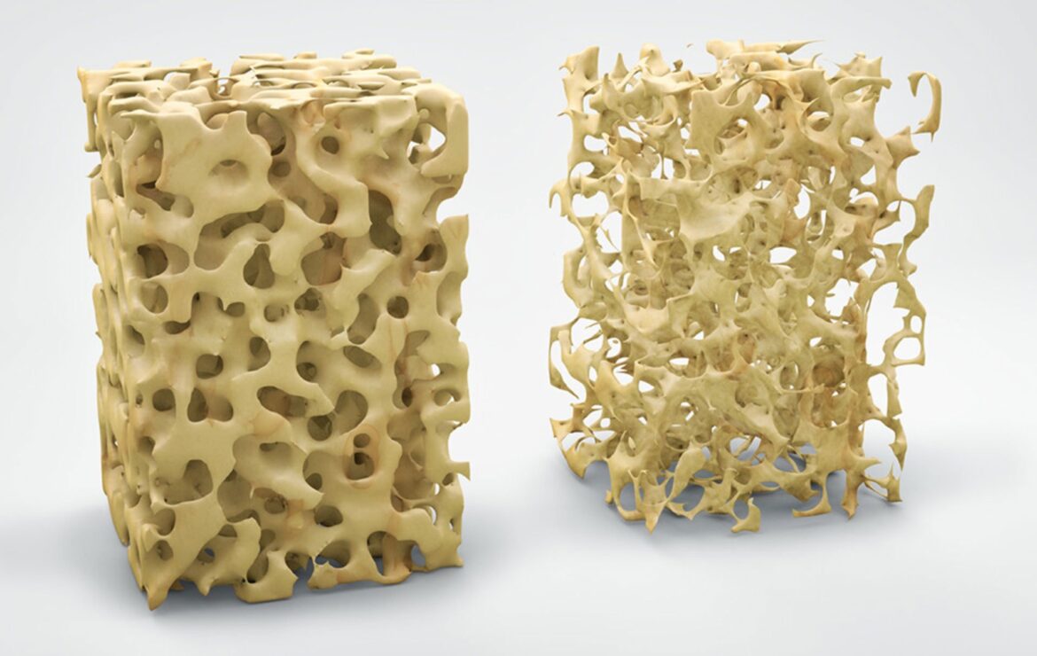 Osteoporosi e denti