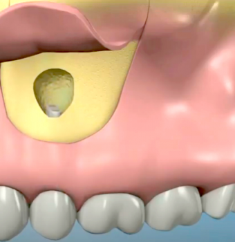 La chirurgia endodontica o apicectomia