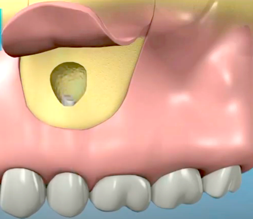 La chirurgia endodontica o apicectomia