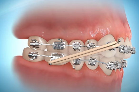 Elastici e apparecchio ortodontico