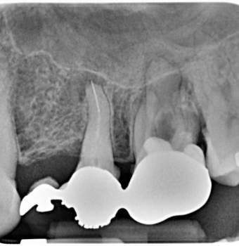 Lo strumento endodontico rotto