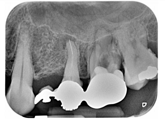 Lo strumento endodontico rotto