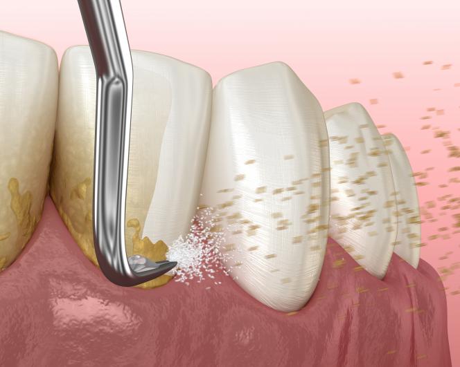 Pulizia dei denti “dolce”